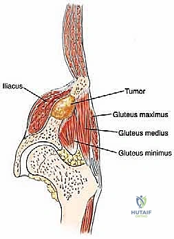 المفصل الصناعي المرتكز على الإسمنت