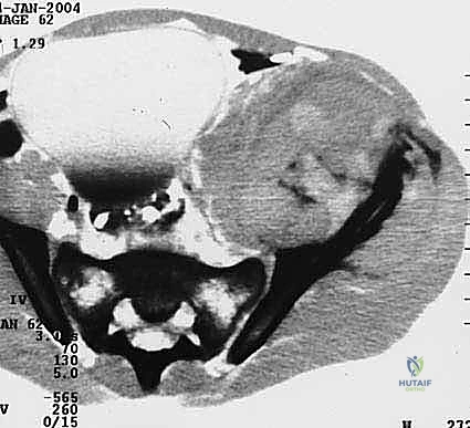 تقنية هارينغتون لإعادة البناء