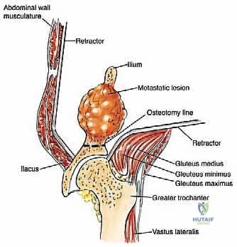 تثبيت الدبابيس المعدنية في الحوض
