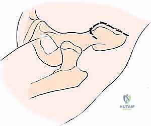 صورة توضيحية لـ جراحة أورام العظام النقيلية في الحوض: دليل شامل للمرضى مع الأستاذ الدكتور محمد هطيف