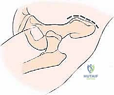 صورة توضيحية لـ جراحة أورام العظام النقيلية في الحوض: دليل شامل للمرضى مع الأستاذ الدكتور محمد هطيف