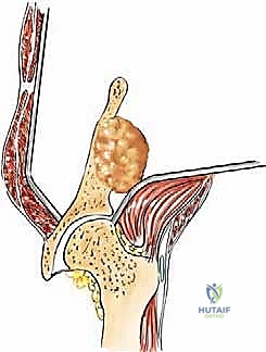 صورة توضيحية لـ جراحة أورام العظام النقيلية في الحوض: دليل شامل للمرضى مع الأستاذ الدكتور محمد هطيف