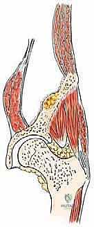 صورة طبية: جراحة أورام العظام النقيلية في الحوض: دليل شامل للمرضى مع الأستاذ الدكتور محمد هطيف
