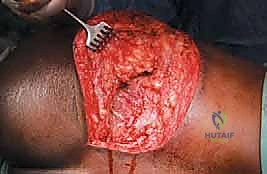 صورة طبية: جراحة أورام العظام النقيلية في الحوض: دليل شامل للمرضى مع الأستاذ الدكتور محمد هطيف