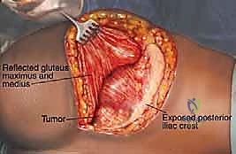 صورة طبية: جراحة أورام العظام النقيلية في الحوض: دليل شامل للمرضى مع الأستاذ الدكتور محمد هطيف