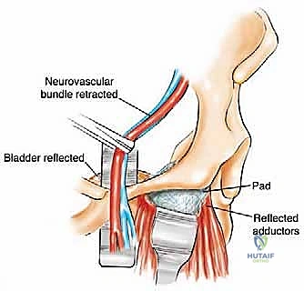 صورة طبية: جراحة أورام العظام النقيلية في الحوض: دليل شامل للمرضى مع الأستاذ الدكتور محمد هطيف