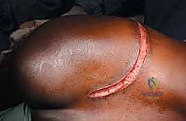 صورة طبية: جراحة أورام العظام النقيلية في الحوض: دليل شامل للمرضى مع الأستاذ الدكتور محمد هطيف