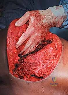 صورة طبية: جراحة أورام العظام النقيلية في الحوض: دليل شامل للمرضى مع الأستاذ الدكتور محمد هطيف