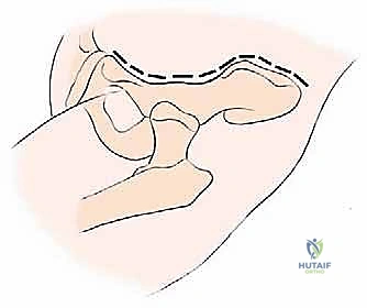 صورة طبية: جراحة أورام العظام النقيلية في الحوض: دليل شامل للمرضى مع الأستاذ الدكتور محمد هطيف