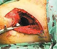 أشعة مقطعية توضح تدمير القشرة العظمية