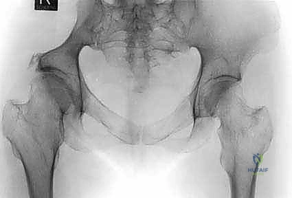 تحديد نوع الورم النقيلي