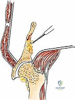 التأثير البيولوجي للورم على نسيج العظم