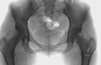 التصوير المقطعي ثلاثي الأبعاد للحوض