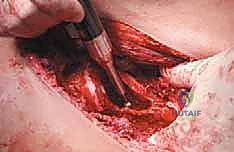 استخدام الإسمنت العظمي والمسامير