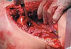 عملية كشط الورم من الحوض