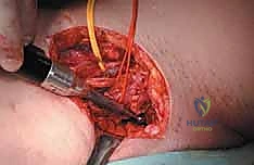 تحديد مدى تدمير العظم قبل الجراحة