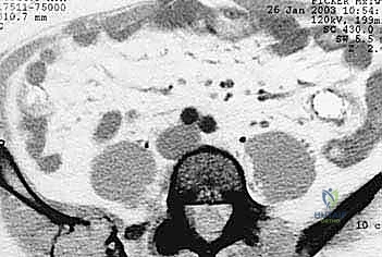 تقييم خطر الكسور المرضية