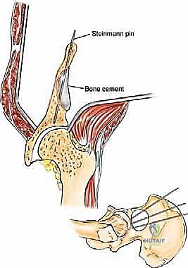 صورة طبية: جراحة أورام العظام النقيلية في الحوض: دليل شامل للمرضى مع الأستاذ الدكتور محمد هطيف