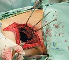 صورة طبية: جراحة أورام العظام النقيلية في الحوض: دليل شامل للمرضى مع الأستاذ الدكتور محمد هطيف