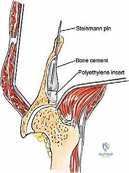 صورة طبية: جراحة أورام العظام النقيلية في الحوض: دليل شامل للمرضى مع الأستاذ الدكتور محمد هطيف