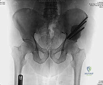 صورة طبية: جراحة أورام العظام النقيلية في الحوض: دليل شامل للمرضى مع الأستاذ الدكتور محمد هطيف