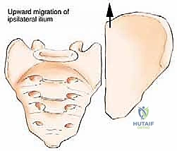 صورة طبية: جراحة أورام العظام النقيلية في الحوض: دليل شامل للمرضى مع الأستاذ الدكتور محمد هطيف