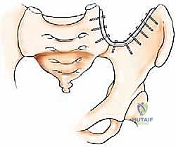 صورة طبية: جراحة أورام العظام النقيلية في الحوض: دليل شامل للمرضى مع الأستاذ الدكتور محمد هطيف