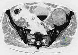 صورة طبية: جراحة أورام العظام النقيلية في الحوض: دليل شامل للمرضى مع الأستاذ الدكتور محمد هطيف