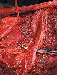 صورة طبية: جراحة أورام العظام النقيلية في الحوض: دليل شامل للمرضى مع الأستاذ الدكتور محمد هطيف