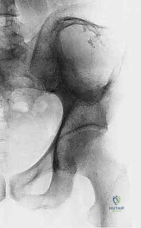 صورة طبية: جراحة أورام العظام النقيلية في الحوض: دليل شامل للمرضى مع الأستاذ الدكتور محمد هطيف