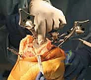 TECH FIG 8  Horseshoe cutting guide is fixed on the proximal tibia