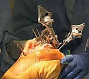 TECH FIG 8  Horseshoe cutting guide is fixed on the proximal tibia