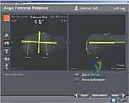 TECH FIG 8  Horseshoe cutting guide is fixed on the proximal tibia
