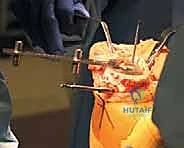 TECH FIG 10  The space for the tibial component keel is prepared using a power burr  A  and impactor  B