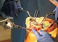 TECH FIG 8  Horseshoe cutting guide is fixed on the proximal tibia