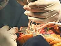 TECH FIG 10  The space for the tibial component keel is prepared using a power burr  A  and impactor  B