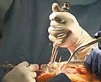 TECH FIG 10  The space for the tibial component keel is prepared using a power burr  A  and impactor  B