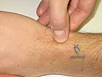 تأثير الإزاحة وعدم التثبيت الجيد على العظم الزورقي