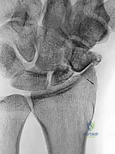 توضيح لتقنية ترقيع العظم الوعائي الظهري 1,2 ICSRA