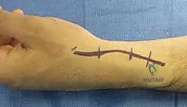 تشريح العظم الزورقي والتروية الدموية التراجعية