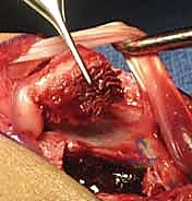 صورة توضيحية لـ ترقيع العظم الوعائي الظهري لعلاج عدم التحام العظم الزورقي: دليل شامل من الأستاذ الدكتور محمد هطيف في صنعاء