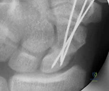 Illustration of bone grafting of avascular - Dr. Mohammed Hutaif