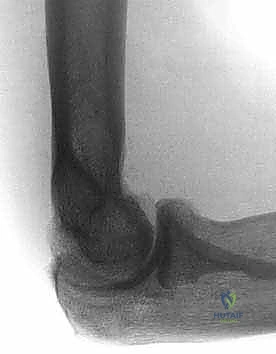 صورة توضيحية لـ تحرير تيبس المرفق بالمنظار: استعادة الحركة والحياة الطبيعية مع الأستاذ الدكتور محمد هطيف