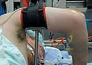 صورة توضيحية لـ تحرير تيبس المرفق بالمنظار: استعادة الحركة والحياة الطبيعية مع الأستاذ الدكتور محمد هطيف