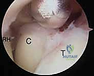 تحديد المداخل الجراحية الدقيقة