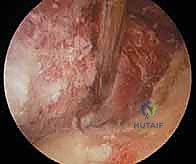 مقارنة بين الجراحة المفتوحة والمنظار