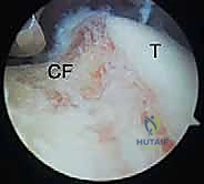 صورة توضيحية لـ تحرير تيبس المرفق بالمنظار: استعادة الحركة والحياة الطبيعية مع الأستاذ الدكتور محمد هطيف