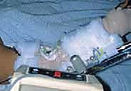 Illustration of treatment of elbow - Dr. Mohammed Hutaif