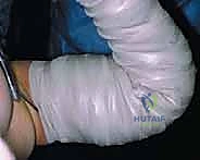 إزالة الأجسام الحرة من المرفق