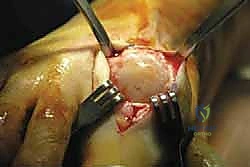 تطور تقنيات علاج تيبس إبهام القدم